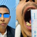 सतत उपलब्धियों का पर्याय बना एम्स, दंत चिकित्सा विभाग ने दिखाया उच्च कौशल, बिना कृत्रिम जोड़ के जन्मजात चेहरे की विकृति का सफल सुधार